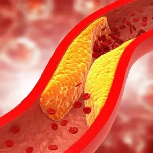 كيف يؤثر ارتفاع الكوليسترول على صحة القلب؟