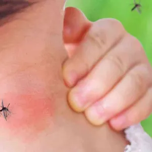 "البعوض" يهدد حياة أكثر من نصف سكان العالم