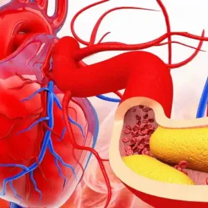 تصلب الشرايين في هذا السن أكثر تأثراً بالضغط والكوليسترول