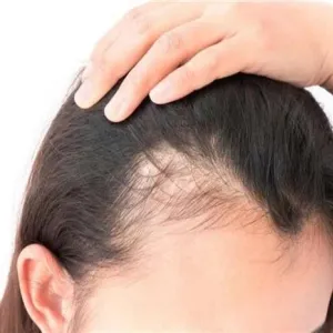 منتجات وعلاجات تساعد في الحد من تساقط الشعر.. تعرف عليها