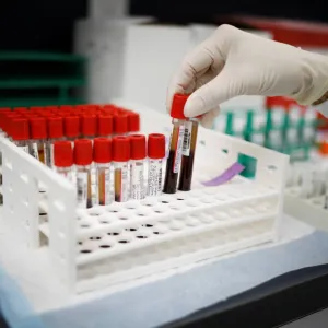 اختبار دم قد يحدد الأشخاص الأكثر عرضة للوفاة بسبب قصور القلب