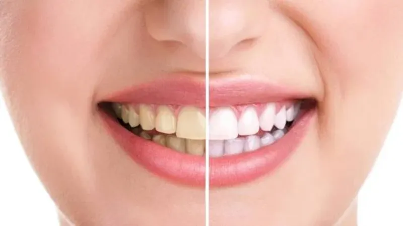 أربع وصفات طبيعية تقضي على اصفرار الأسنان