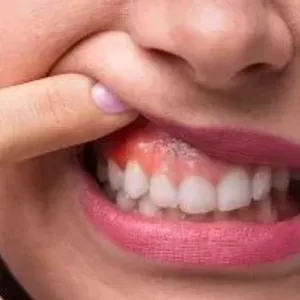 علامات ظاهرة وعوامل تزيد فرص الإصابة بتقرحات الفم والشفاه