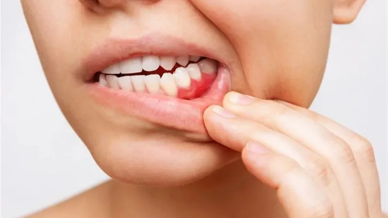 علامات تظهر في الفم تشير لإصابتك بالسكري- هل تعاني منها؟