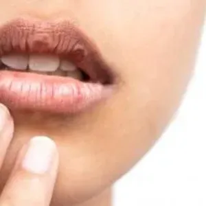 لو بتعاني من تقشر الجلد حول فمك.. 5 طرق طبيعية تساعد فى العلاج