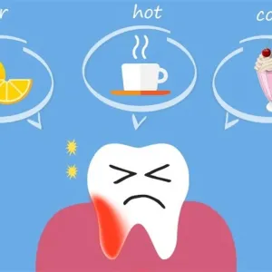 س & ج- دليل شامل عن حساسية الأسنان المفاجئة