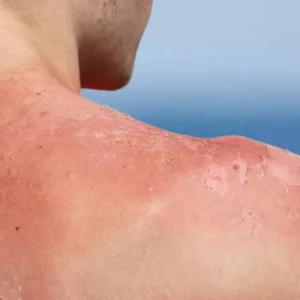 نصائح للتخلص من التهابات الجلد خلال فصل الصيف
