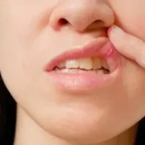كيف تقى نفسك من التعرض لقرح الفم ؟