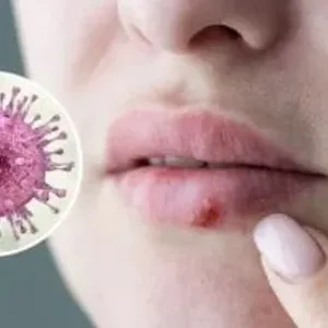 اليوم العالمي للتقبيل.. 8 أمراض تنتقل عن طريق القبلات أخطرها التهاب السحايا