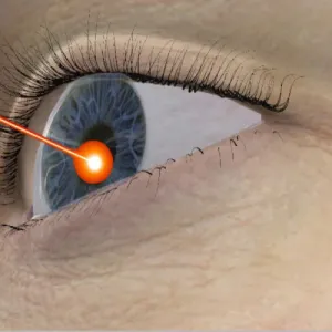 غير قانونية وخطرة.. نقابة أطباء العراق تمنع عمليات تغيير لون العين