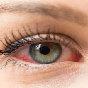 5 طرق للحفاظ على العين عند استخدام الهاتف.. احذر فقدان البصر