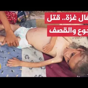 الجزيرة ترصد حالات لسوء التغذية الحاد بين الأطفال في قطاع غزة