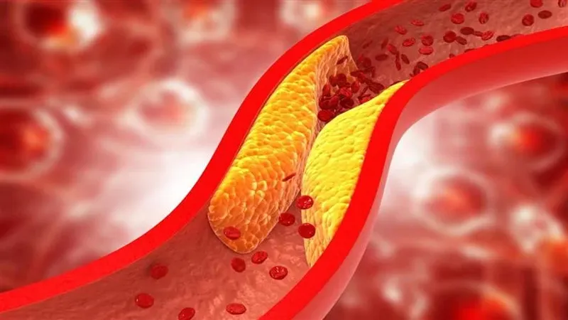 كيف يؤثر ارتفاع الكوليسترول على صحة القلب؟