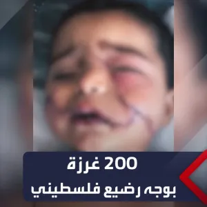 200 غرزة بوجهه وبترت يده.. مناشدة لعلاج الطفل "سند" الذي أصيب في القصف على #غزة  #العربية