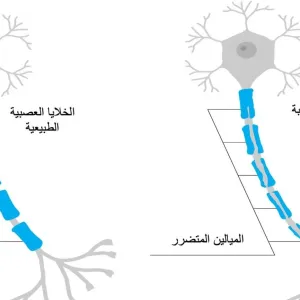 التصلب العصبي المتعدد: أعراض خفية متجاهَلة تظهر في العقد الثالث