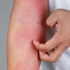 تخلص من الحكة.. 6 علاجات منزلية لتخفيف التهاب الجلد في الصيف