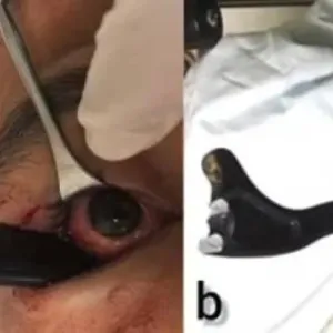 عملية جراحية في عين رجل لإخراج مقبض فرامل!