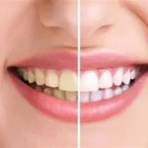 ما مميزات تلميع الأسنان؟.. إليك الطرق الأفضل