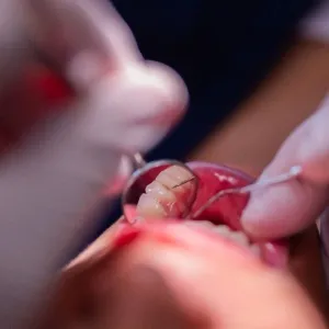 خراج الأسنان.. 7 نصائح للوقاية من الألم الخطير