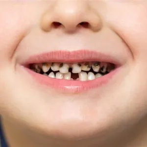 4 أعراض احذرها في أسنانك الأمامية- استشر الطبيب فورًا