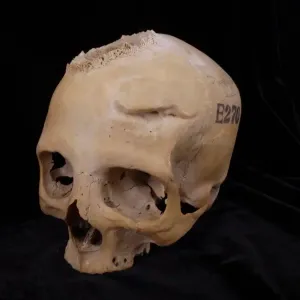 جمجمة تكشف..المصريون القدماء حاولوا معالجة السرطان منذ 4000 عام