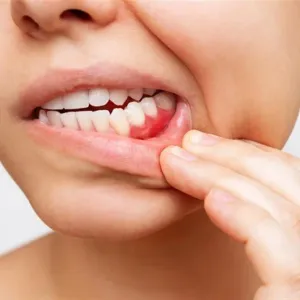 علامات تظهر في الفم تشير لإصابتك بالسكري- هل تعاني منها؟