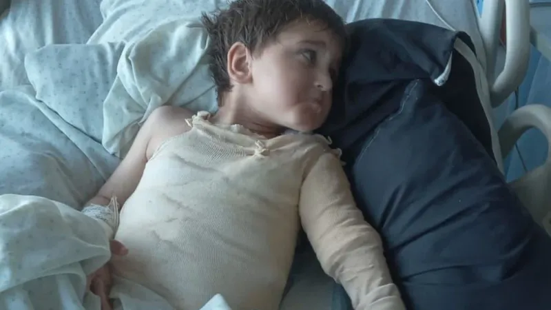 عمر ابن الثلاث سنوات يعاني حروقاً من الدرجتَين الثانية والثالثة: صرخة استغاثة