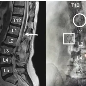 تقنية جديدة لمراقبة الأعصاب خلال جراحات العمود الفقري تتجاوز «المعايير الذهبية» الحالية